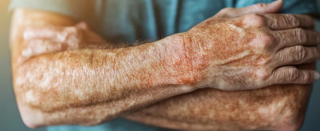 Artrite psoriásica aposentadoria: entenda quando a doença pode dar direito ao benefício