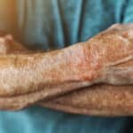 artrite psoriásica aposentadoria