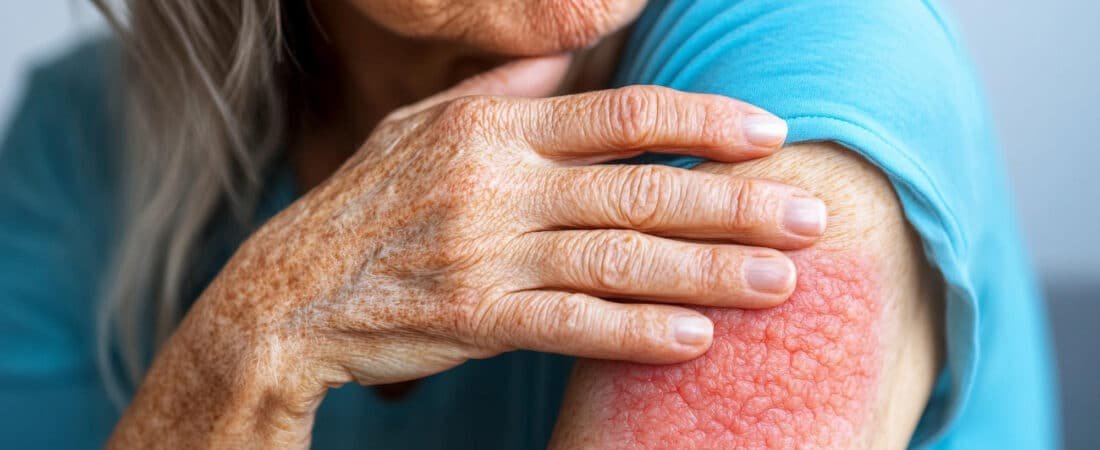 Hanseníase gera aposentadoria? Entenda quando a doença pode dar direito a benefício