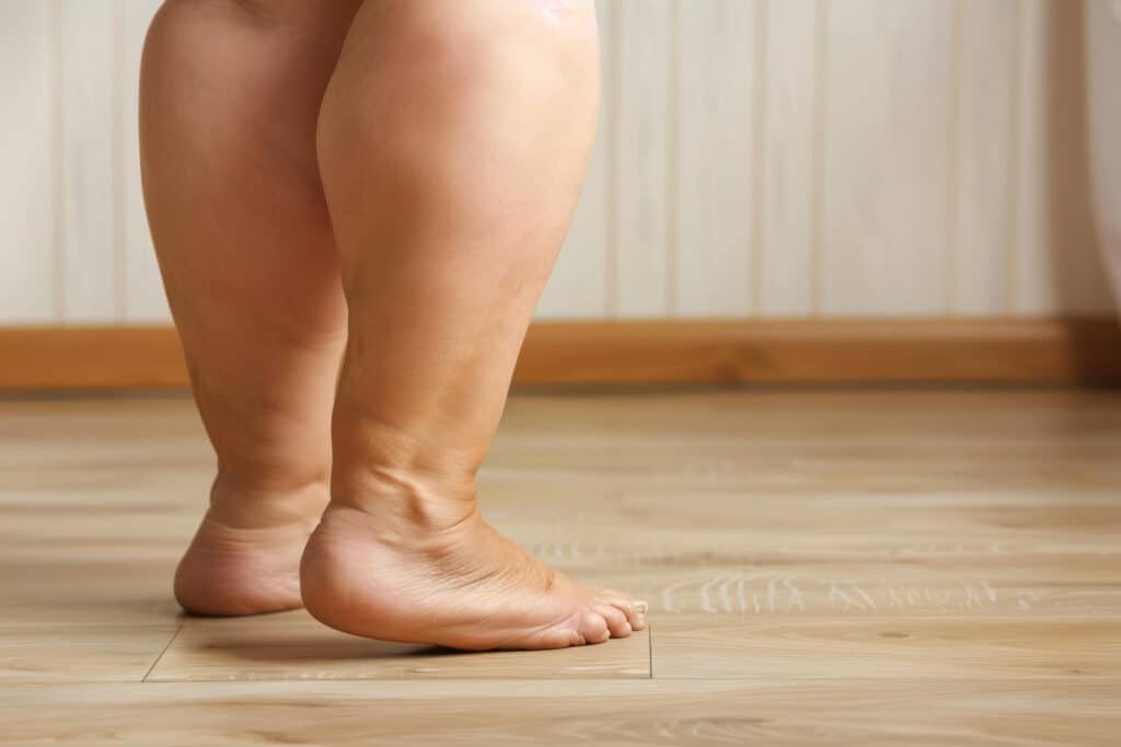 lipedema gera aposentadoria