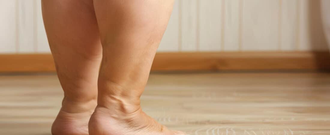 Lipedema gera aposentadoria? Entenda quando a doença pode dar direito a benefício