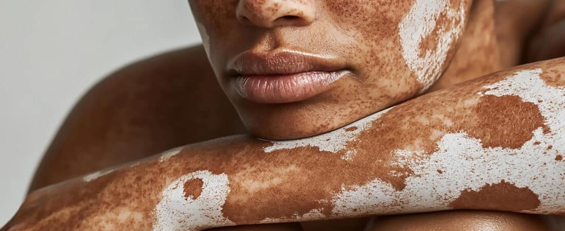 Vitiligo gera aposentadoria? Entenda quando a doença pode dar direito a benefício previdenciário
